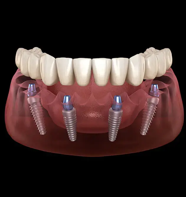 all on 4 dental implant