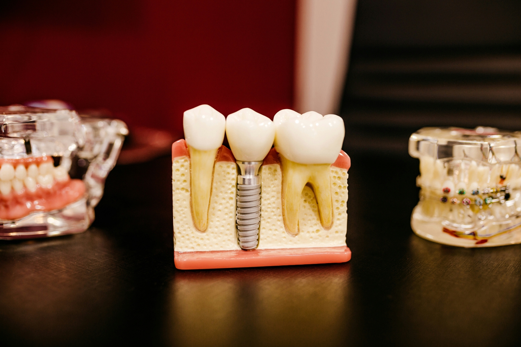 dental implant diagram on desk