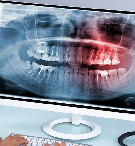 wisdom teeth in a dental xray